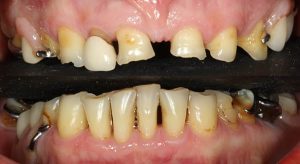 worn teeth failed crowns bridgework