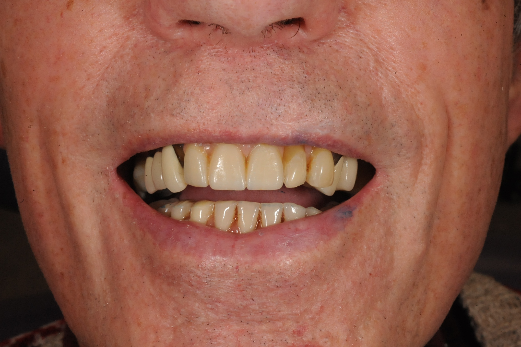 Invisalign Fall Accidental fall leading to loss of 4 front teeth - Forma Smile ...